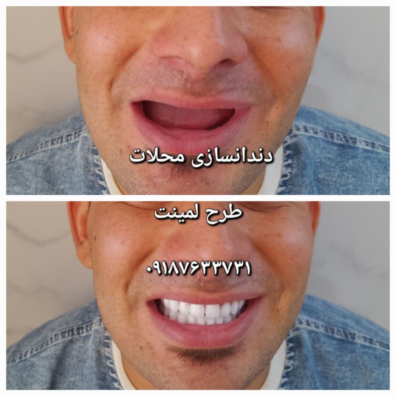 دندانسازی محلات - دندان سازی محلات